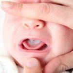 how to treat thrush in newborns